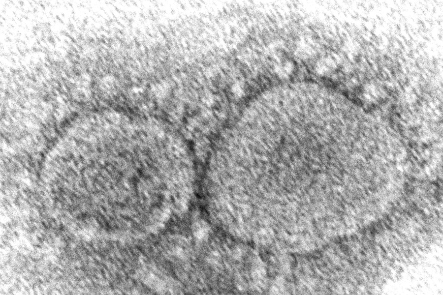 Electron microscope image of SARS-CoV-2 virus particles