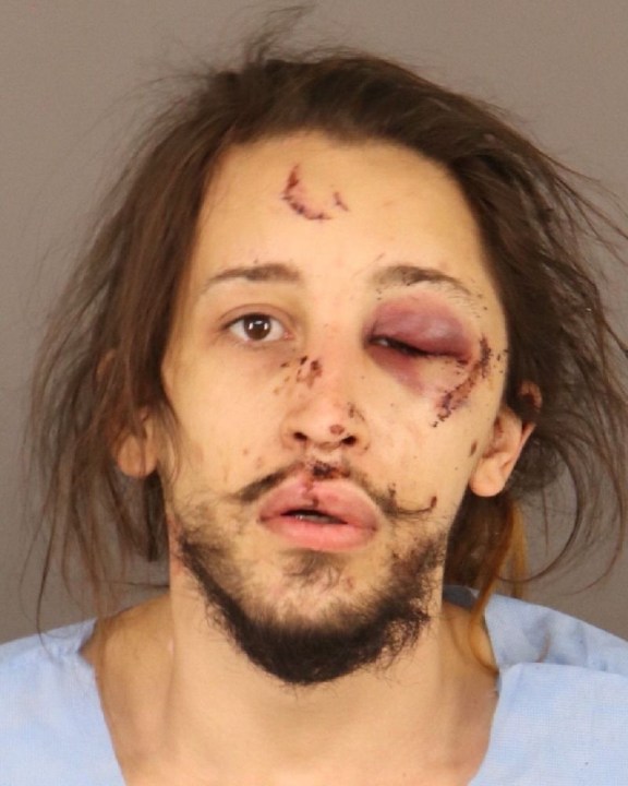 Nicholas Villarini booking photo with brusies on his face and a black eye